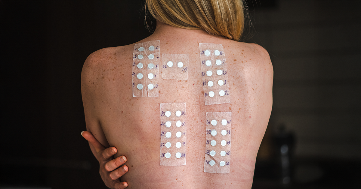 How Does Dermatologist Patch Testing Work